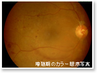 増殖期のカラー眼底写真